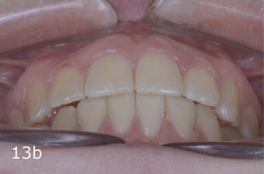 Figs. 13a–f: Final situation. The lack of overjet and overbite and the midlines had been improved and anterior and canine guidance achieved.