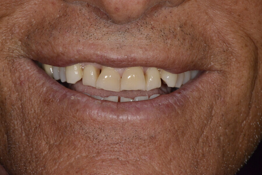 Figs. 11a–e: Resting position, smile and intra-oral frontal and lateral photographs.