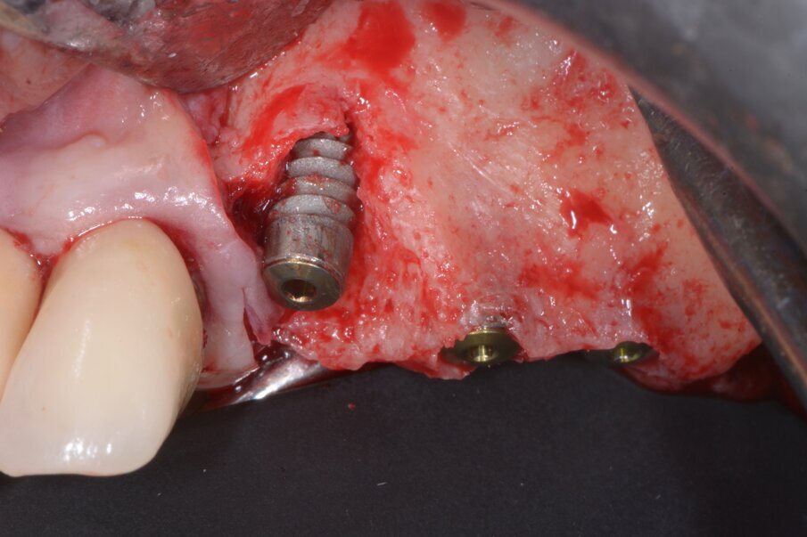 Fig. 7 - Impianti posizionati in sede 23, 24, 25.