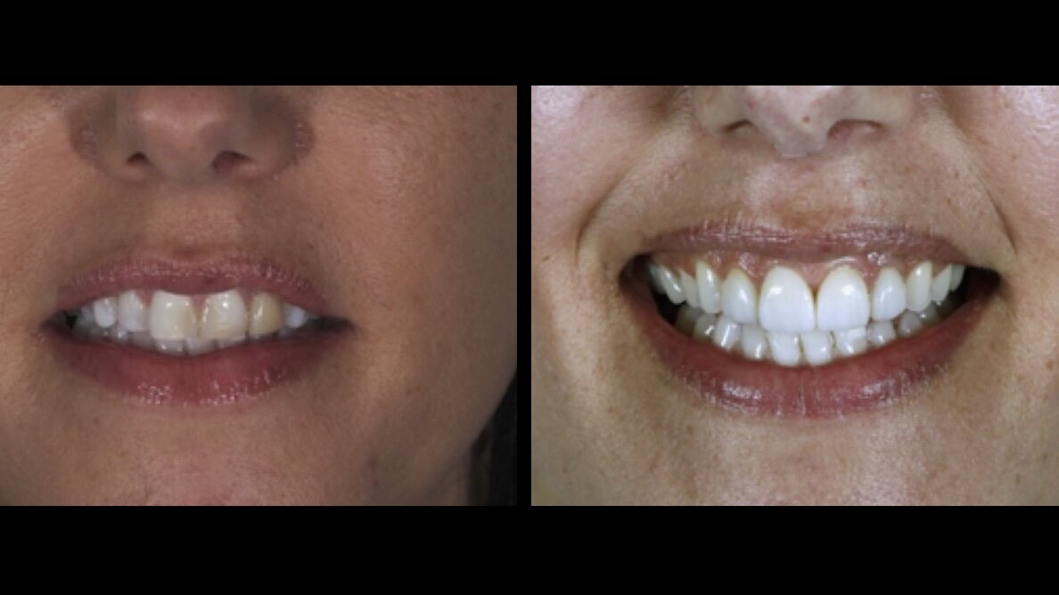 Abordaje perio-estético-restaurador