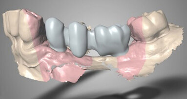 Rehabilitace pomocí kónických implantátů, augmentace kosti a keramického vhojovacího abutmentu