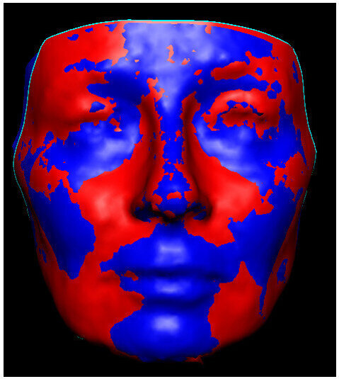 Fig. 6: Morphological facial changes in the lips, zygoma and jowl area after the placement of 1 ml Restylane and 1.3 cc Radiesse. Note the deeper red to orange colour in the areas where the injections were placed.
