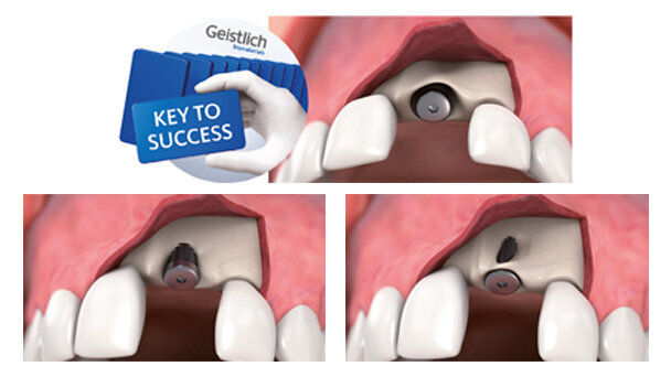 Trattamento dei difetti ossei minori:  fattori chiave per il successo