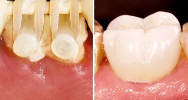 Webinar thematisiert Extrusionstherapie