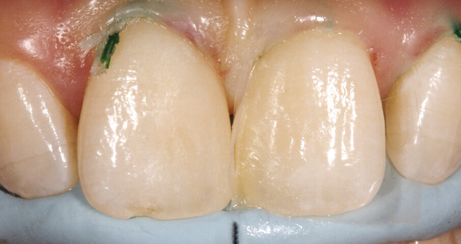 7. Situacija nakon završetka modeliranja. Mora se uzeti u obzir posvjetljenje prirodne boje zuba uzrokovano dehidracijom.