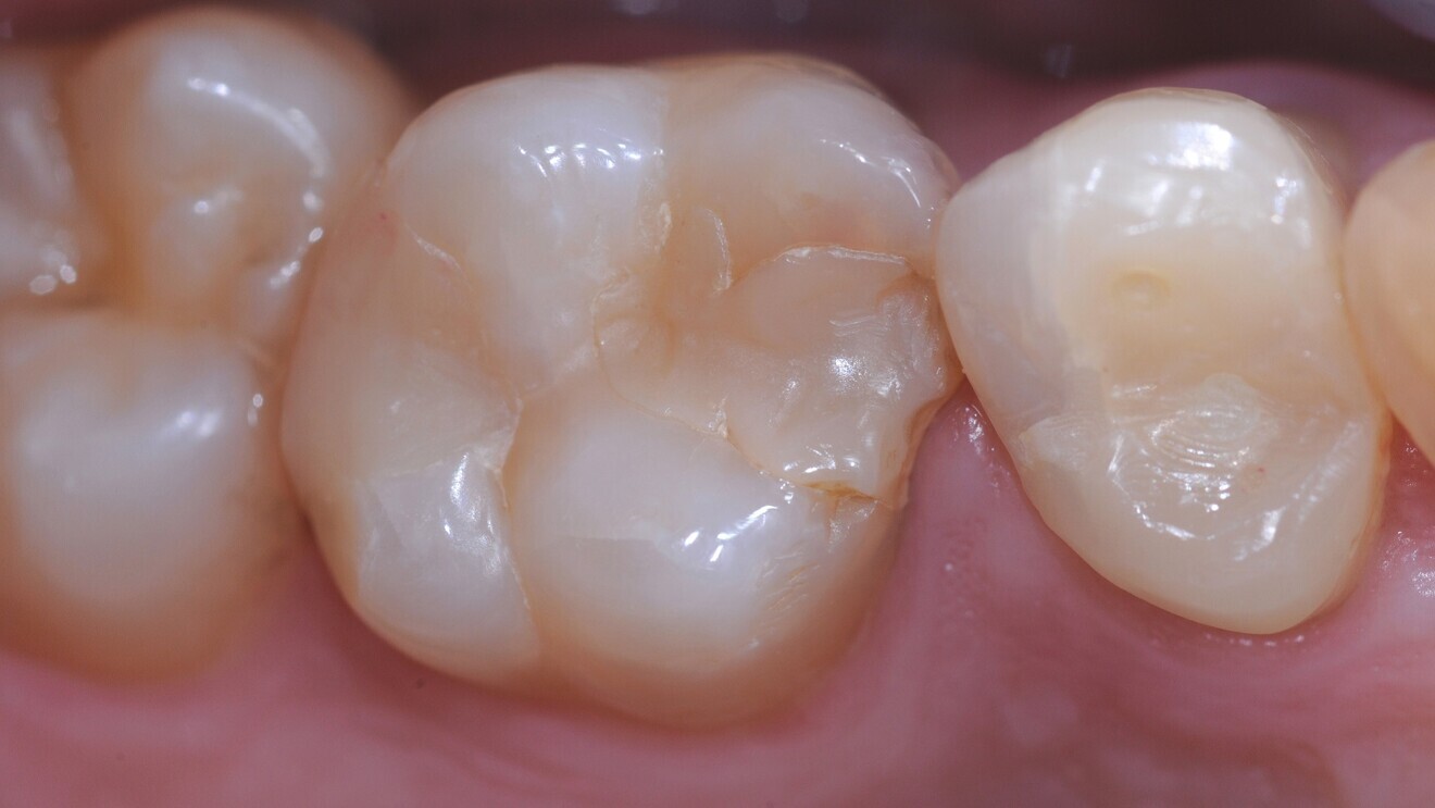 Fig. 7: Class II restoration on tooth #26 with secondary caries.