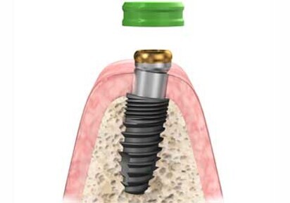 Stern SNAP Angled Overdenture Implant Abutment System