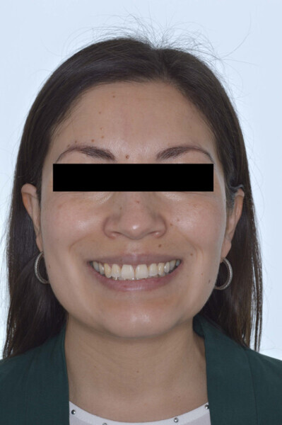 Fig. 8b: Final extra-oral photographs one month after botulinum toxin administration.