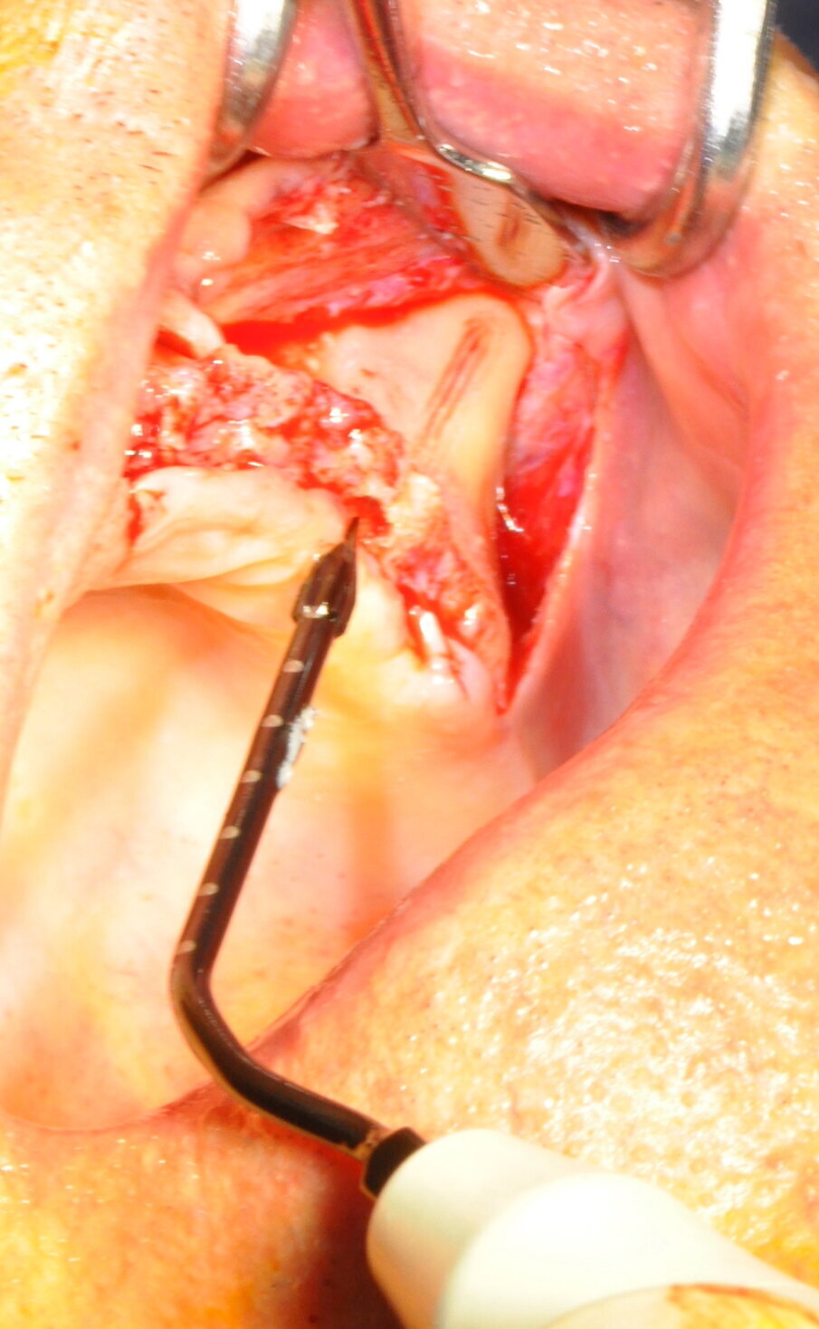 Figg. 11-14 - Preparazione finale.