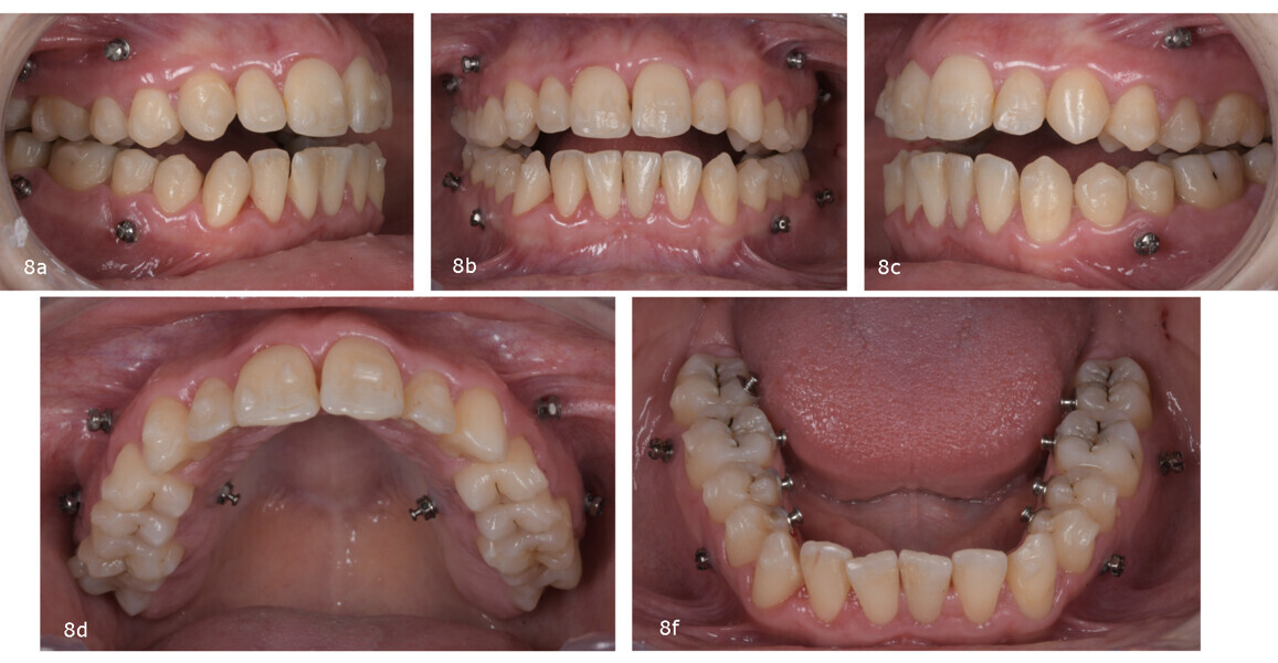 Figs. 8a–e: Situation after placement of the maxillary and mandibular attachments and mini-screws.