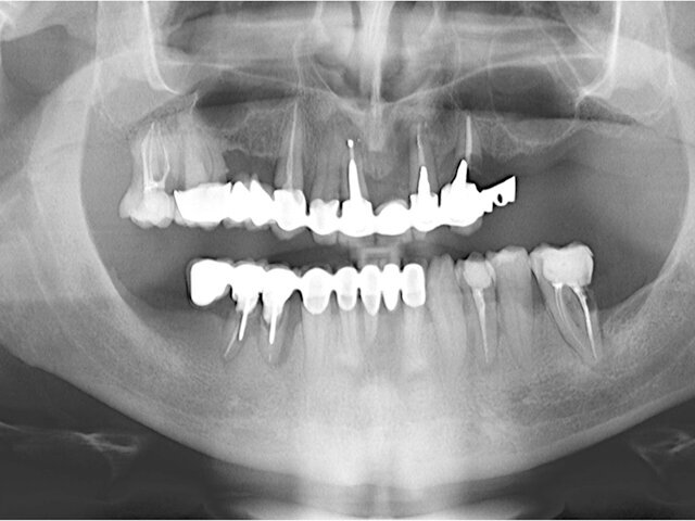 Panoramatický RTG snímek situace před ošetřením
