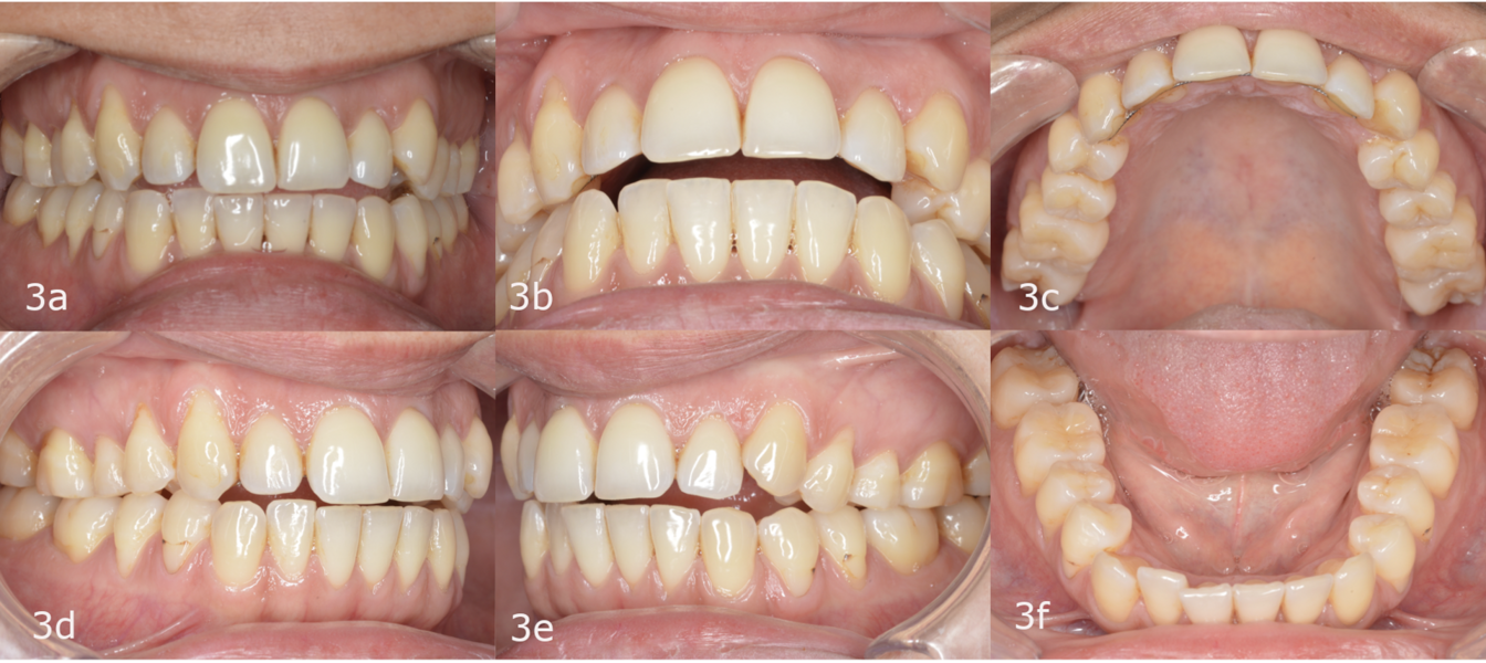 Figs. 3a–f: Pretreatment intra-oral photographs.