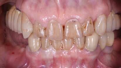 Risoluzione di una grave atrofia ossea con la tecnica della lamina corticale e materiali innovativi