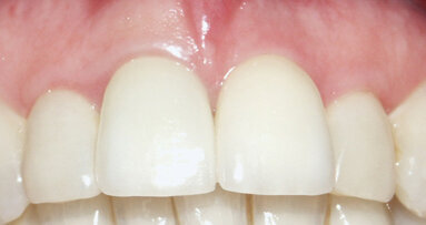 Immediate single-tooth replacement, provisionalization