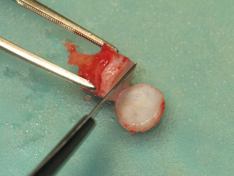 Fig. 25 : Élimination de la gencive kératinisée. 