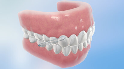 Align Technology introduces Invisalign G3 Align Technology introduces Invisalign G3
