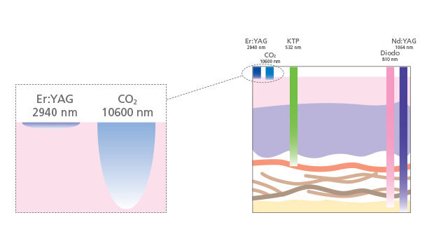 Dispositivi orali e laser per il russamento