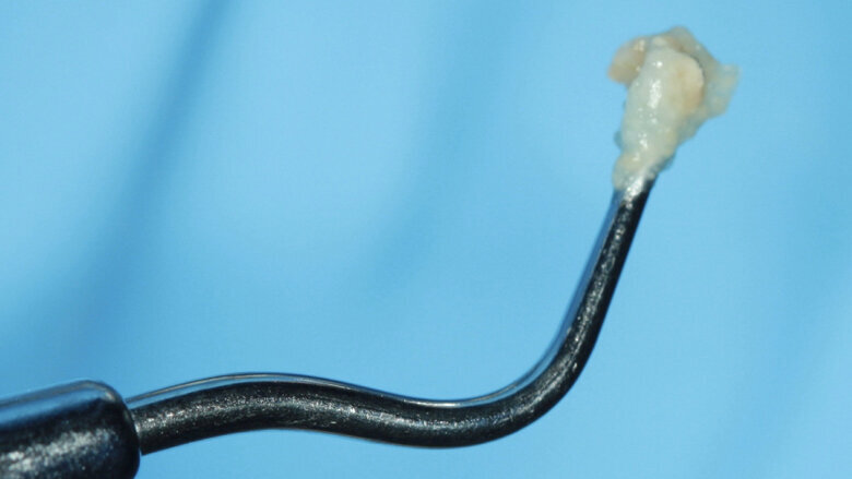 Figuras 8 y 9. Se complementa la instrumentación mecánica en el límite amelo-dentinario.