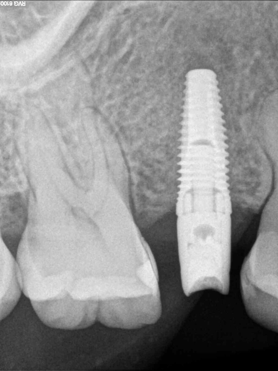 Fig. 24 - Radiografia dopo connessione abutment definitivo.