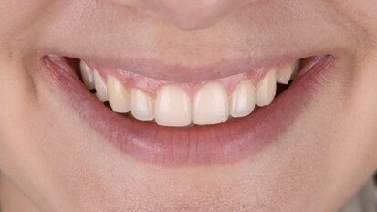 3D-printing inlays, onlays and overlays with SprintRay: A revolutionary approach to dental restorations