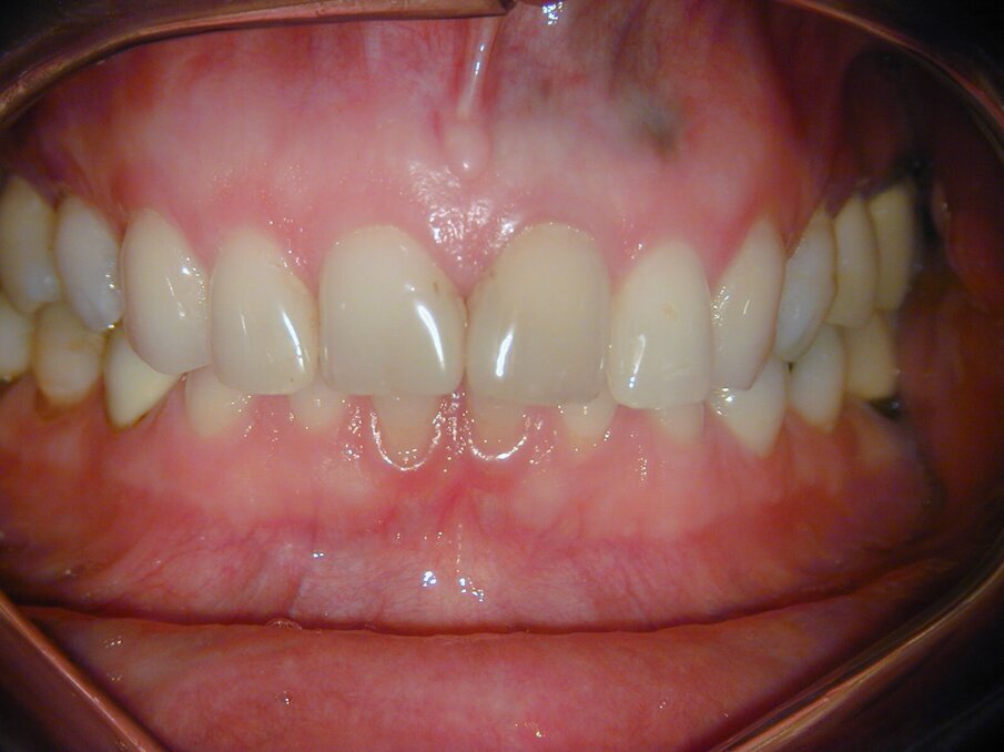 Afb. 9-11: Klinische foto’s van de 37-jarige follow-up