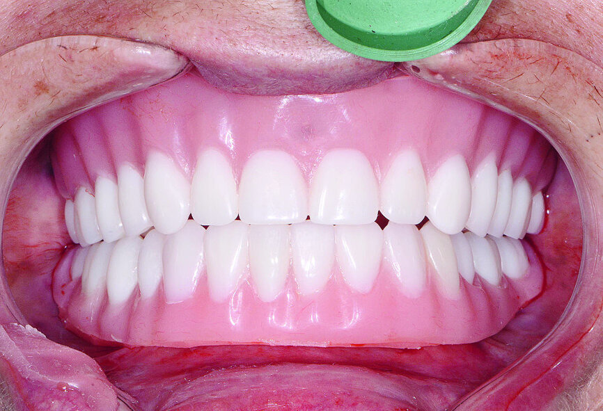 Fig 16 Prothèses immédiates rebasées par un matériau souple