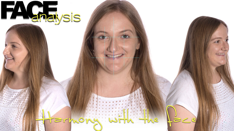 Fig. 6_Impatto estetico dei denti frontali sul viso della paziente.