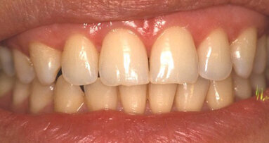 La difusión de la luz en las restauraciones directas