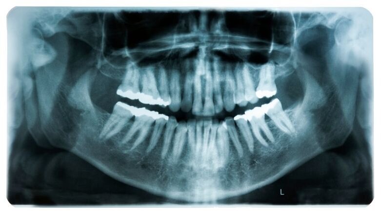 Analyse van tandheelkundige röntgenfoto’s door AI bespaart tijd in patiëntenzorg