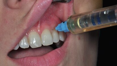 Korak dalje – lokalna anestezija ili paraformaldehid?