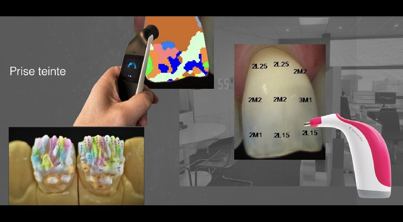 Fig. 6: Shade taking with a spectrophotometer using the Rayplicker Cobra (Borea) or VITA Easy-Shade V (VITA Zahnfabrik).