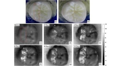 Aparelho de imagem de baixo custo pode facilitar a detecção precoce de cáries