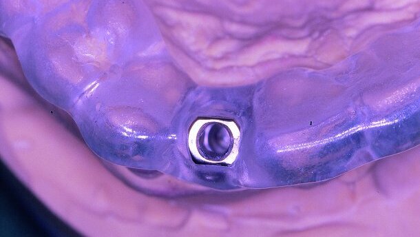Les années les plus marquantes de l’implantologie - Une rétrospective très personnelle