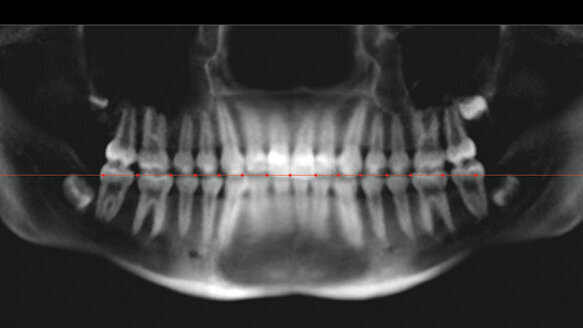 Comparison of tooth mesiodistal angulation measurements