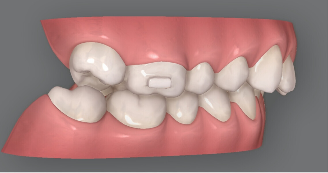 Figs. 7a–c: ClinCheck progression of the patient, showing the planned semi-sequential distalisation of the posterior teeth and overcorrection of the overbite.