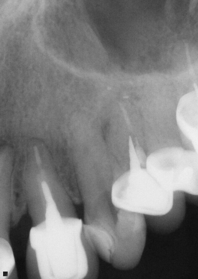 Fig. 11: Presentation of tooth 11 with caries on the ML and hot sensitivity and pain reported by the patient.