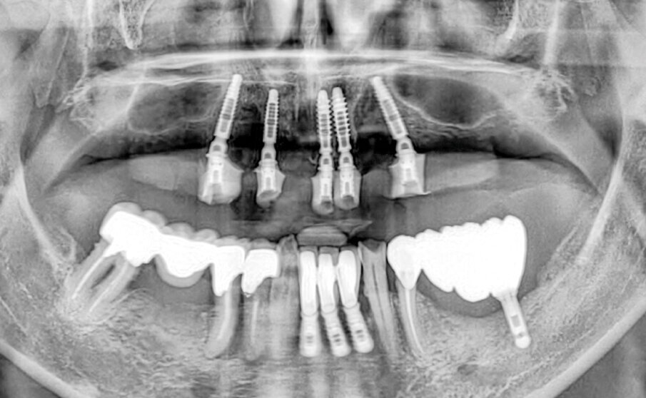 Fig. 9 - Radiologia impianti, MUA, cilindri da incollaggio (protesi provvisoria).