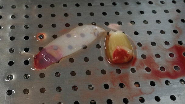 Efficace, indolore e senza  effetti collaterali o indesiderati: ecco i vantaggi della terapia con L-PRF