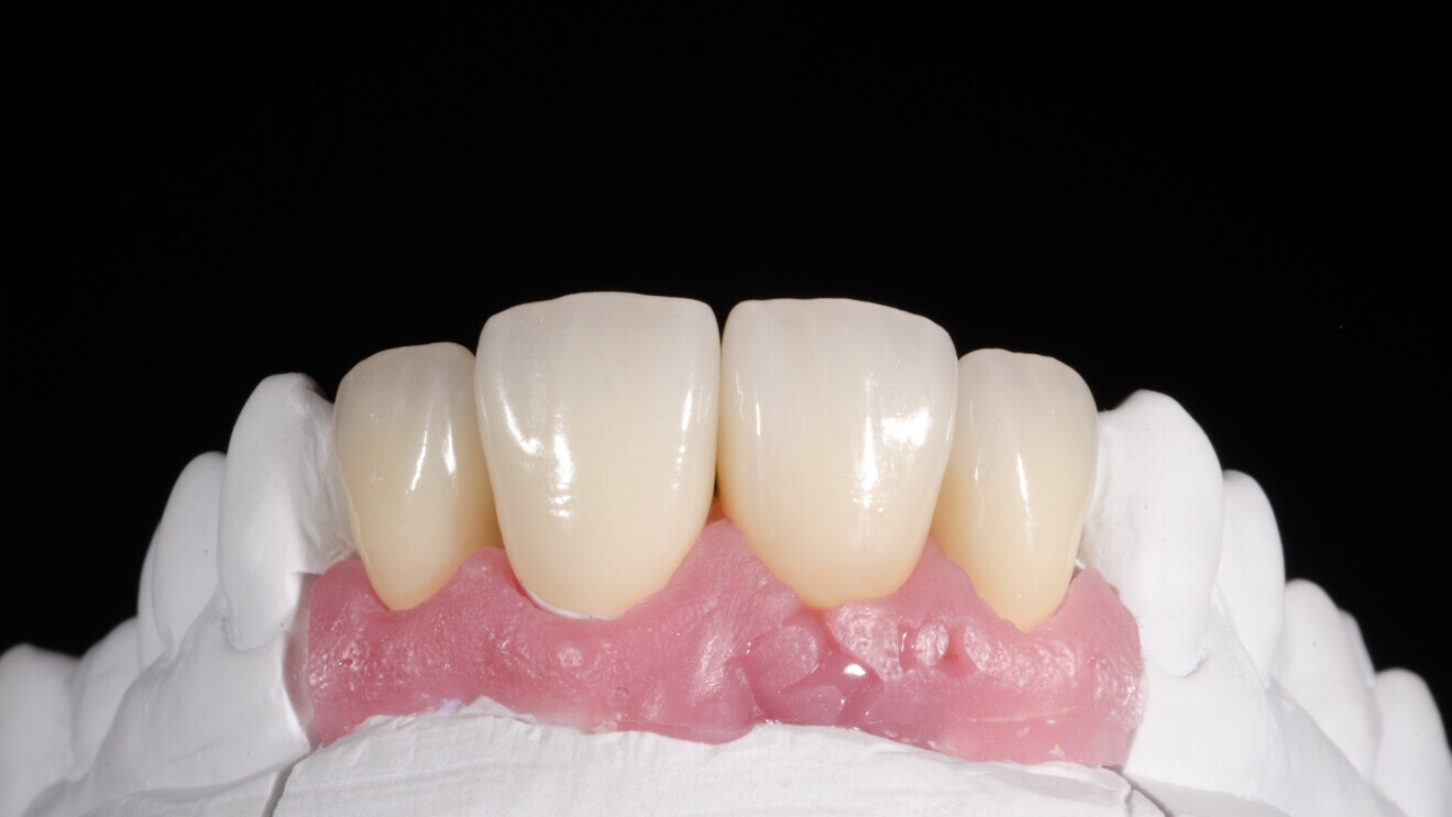 Fig. 5: Finished crowns on the model. 