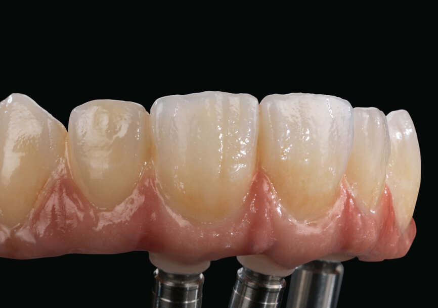 Zolid HT+ White kam 2017 auf den Markt und war der erste Rohling für monolithische, weitspannige Brücken. © Alexander Wünsche/Zahntechnik