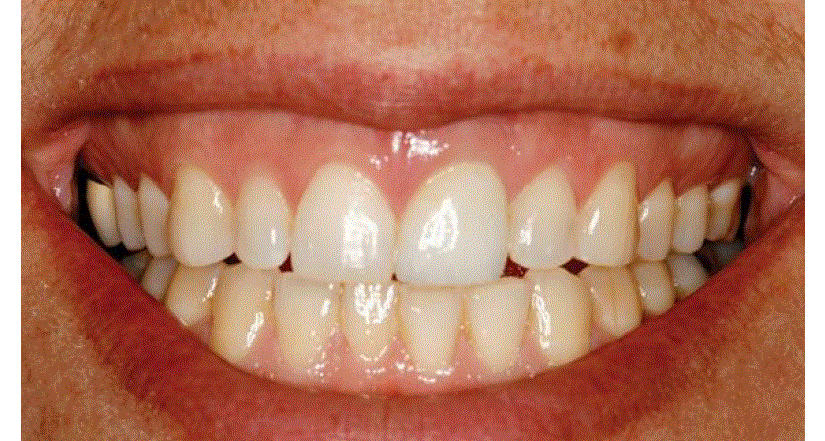 La dentisterie restauratrice basée sur l'implant : le futur, c'est maintenant !