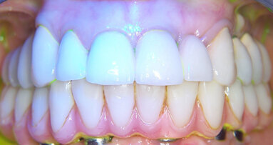 Utilizzo della terapia fotodinamica Helbo nel trattamento delle perimplantiti: case report