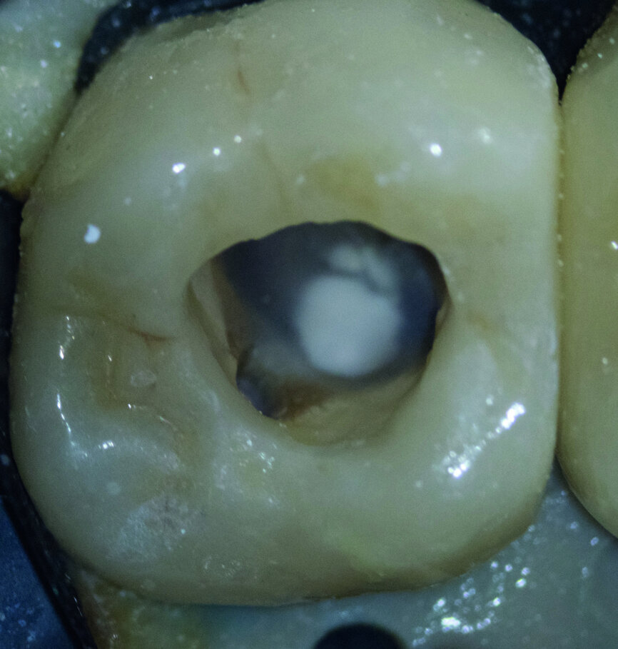 Fig. 11 : Sablage avant la fermeture par everX Flow.