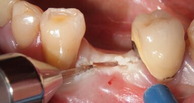 Valutazioni preliminari di inserti in Zaffiro e laser a diodi 915nm in chirurgia implantare