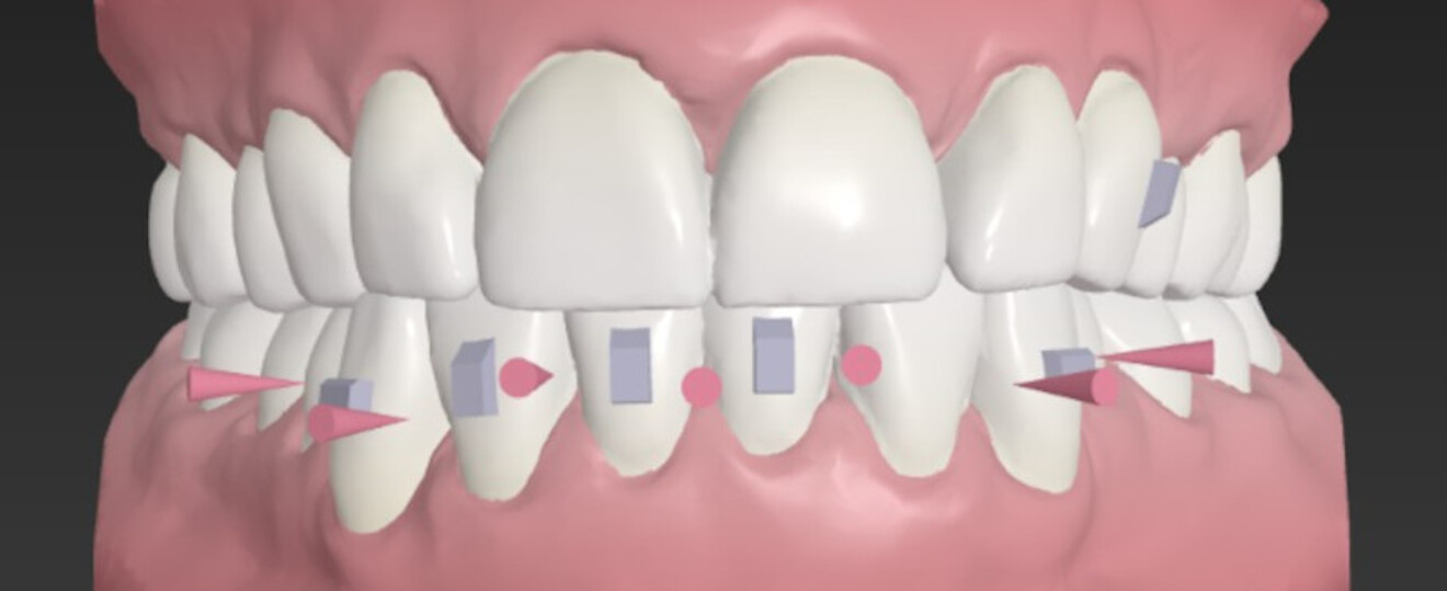 Fig. 5a: Interproximal reduction and attachments planned with ClearCorrect aligners, frontal view.