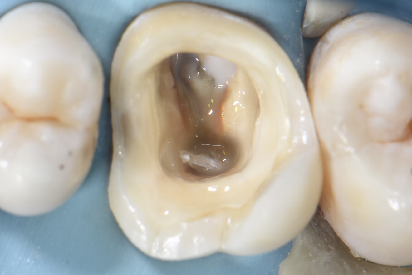 Fig. 10: Cavity sealed with flowable composite and canal openings blocked with the liquid dental dam and PTFE tape.