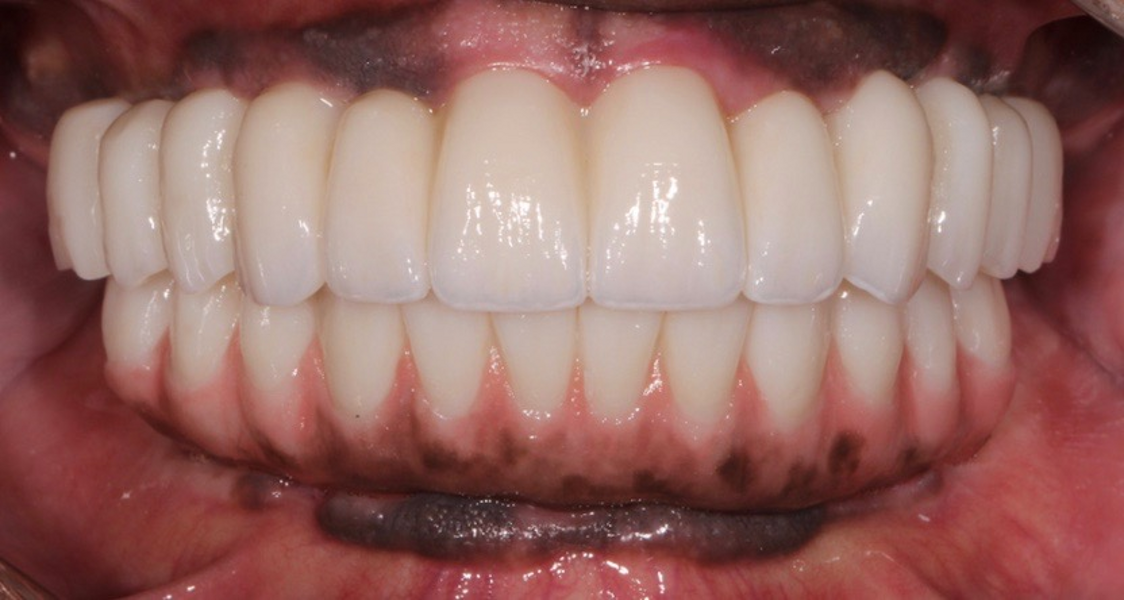 Fig. 30: Frontal view of the patient’s improved vertical dimension, function and aesthetics.
