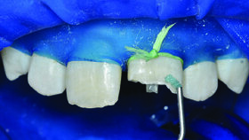 Kompozitni kočići ojačani vlaknima: jednostavno do pouzdanih nadogradnji