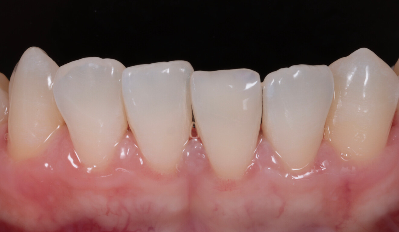 Fig. 23: Final treatment outcome.