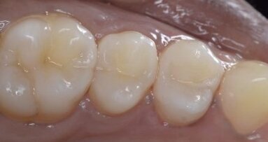 Keys to predictable posterior restorations: Bulkfill and modern matrix systems